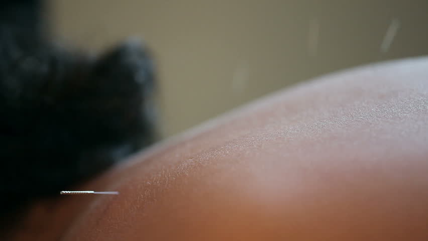 Macro detail of an acupuncture needle being inserted and adjusted in back 