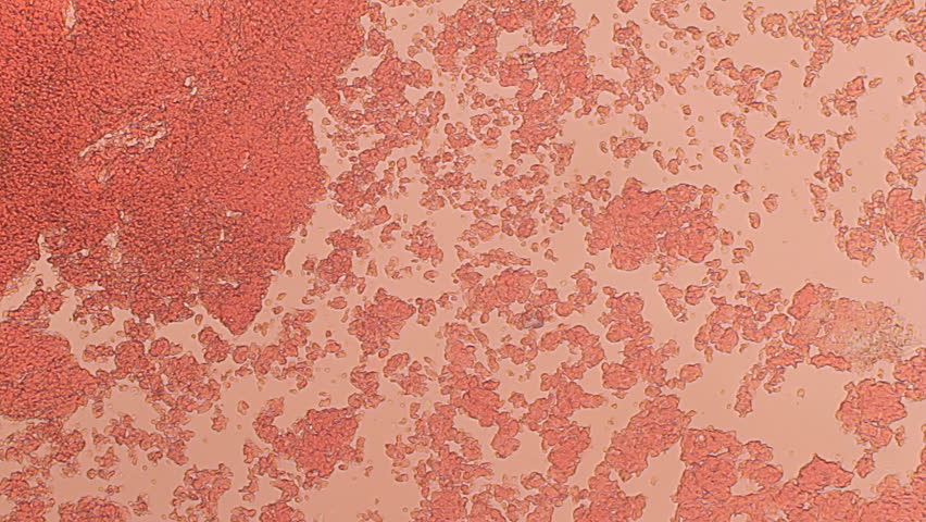 Blood Clotting Wide View 100x (HD 24p). Blood Platelets seen forming a clot at 100x magnification with the aid of a halogen bacteriological microscope.