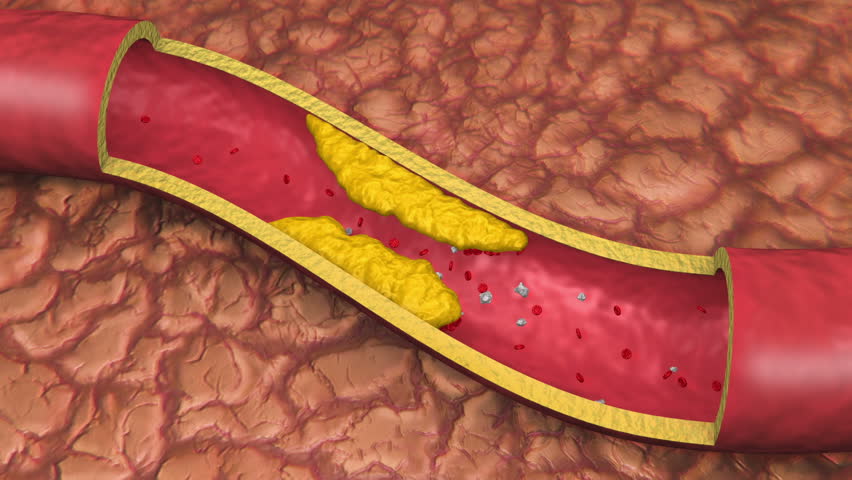 Artery With Clog Animation (HD). Clogged artery shown with a cut out section displaying fat deposits and forming a clot. White Platelets in Bloodstream.