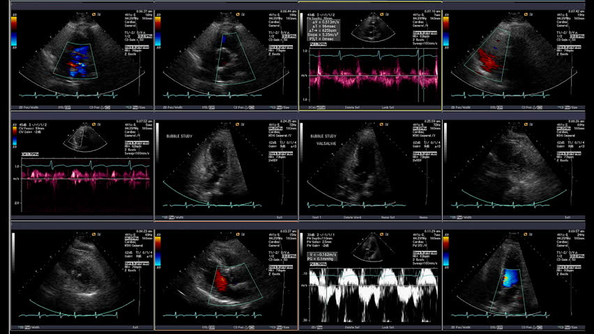 Echocardiogram 12 view screen capture of heart beating