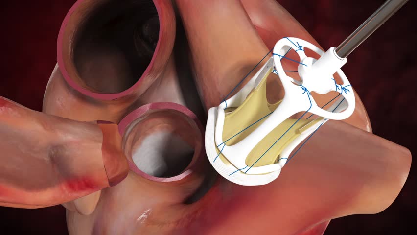 Digital detailed cardiac valve replacement surgery of the aortic tricuspid semilunar valve with prosthetic valve in anaesthetized patient