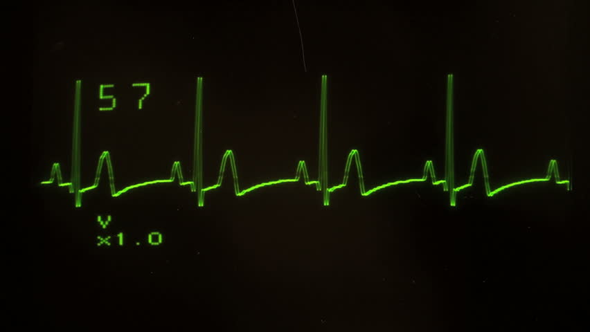 EKG defibrillator screen heart flatlines - with sound, HD 1080