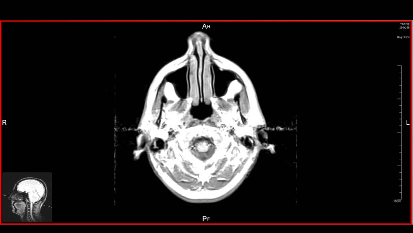 Brain top MRT scan