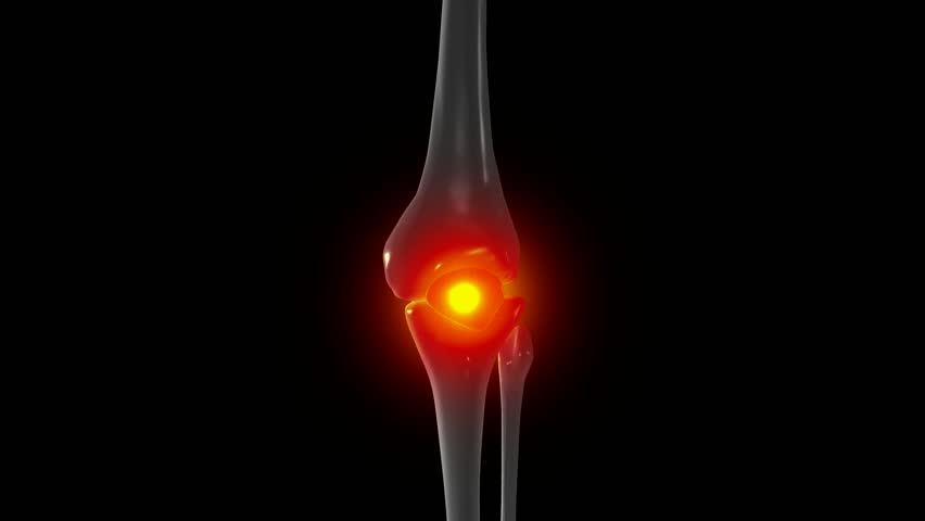 x ray of knee showing knee pain 