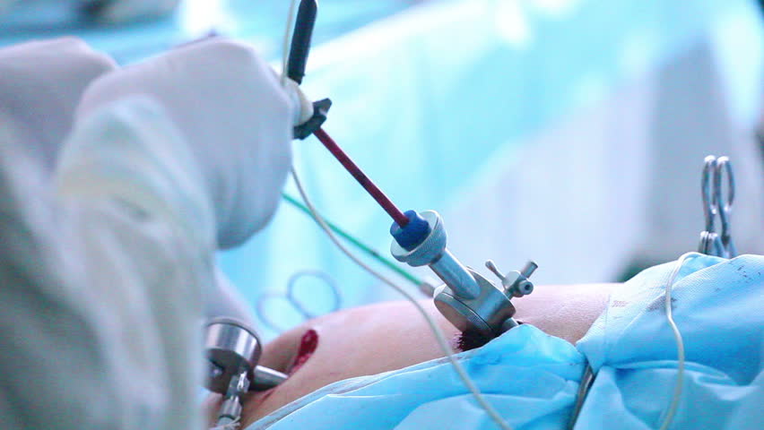 Laparoscopic surgery of the abdomen 5