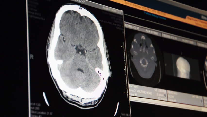 A doctor examines a head MRI scan on a computer screen.