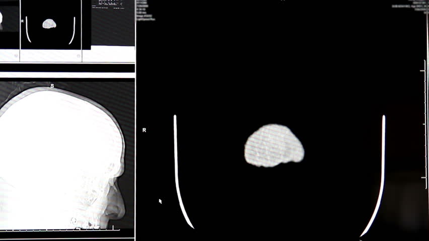 A doctor examines a head MRI scan on a computer screen.