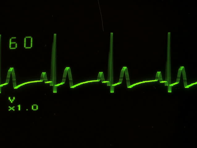 EKG screen close-up flat line - NTSC