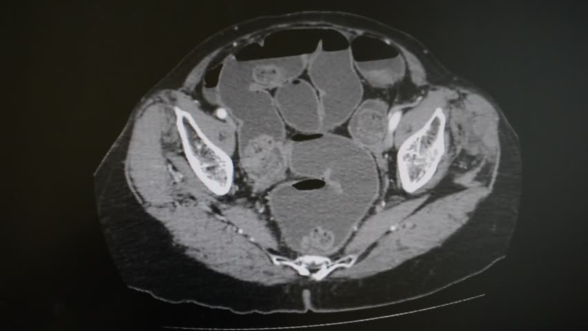 Header of Abdomen