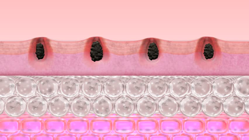 Header of remove