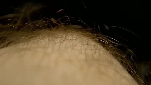 Pubic Lice Crawling Through Hair On Stock Footage Video (100% Royalty-free)  15542248 | Shutterstock