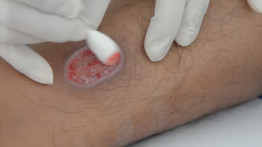 Cleaning Infected Tattoo Wound Stock Footage Video 100 Royalty