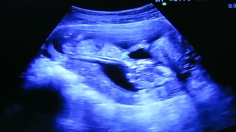 Ultrasound at 13 weeks