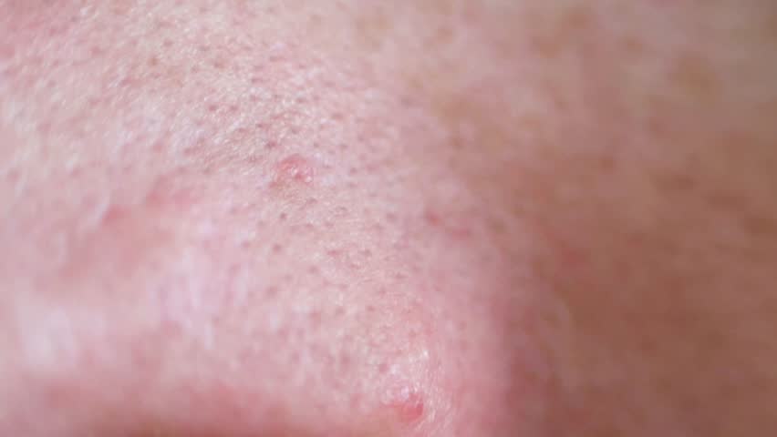 Header of blackhead
